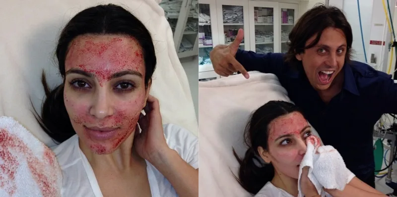 Kim K Blood Facial
