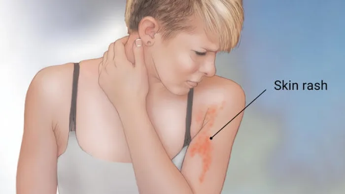 Typhoid Fever_resized