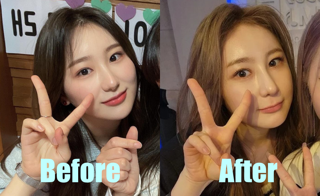 Fans React Negatively To Ex-Iz*One Member Lee Chaeyeon'S Alleged Nose Job -  Hype My